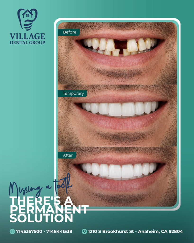 Healthcare Social Media Marketing 2 Before, temporary, and after views of a smile with missing teeth, showing dental restoration results