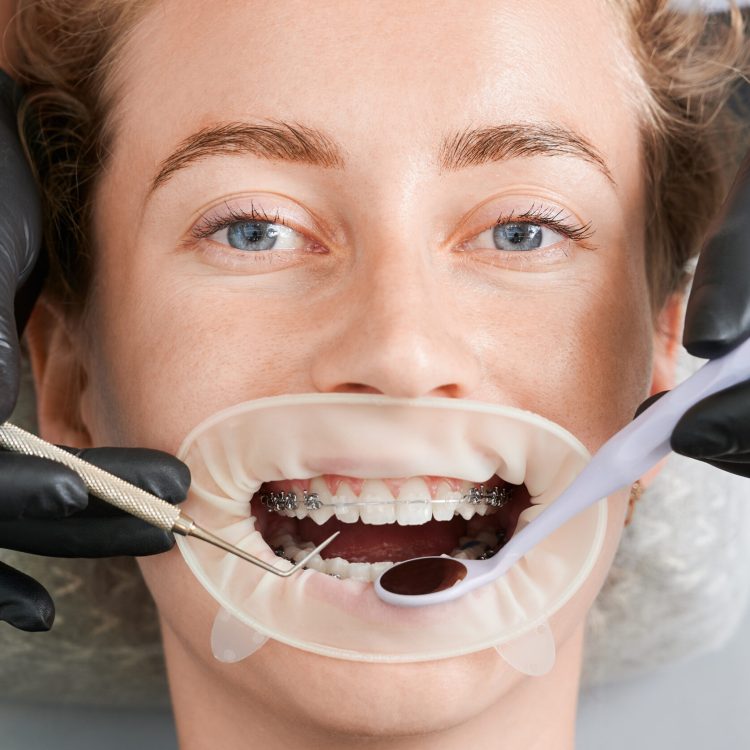 Close up of dentist placing orthodontic brackets on patient teeth. Young woman with metal braces on teeth having dental procedure. Concept of stomatology, dentistry and orthodontic treatment.
